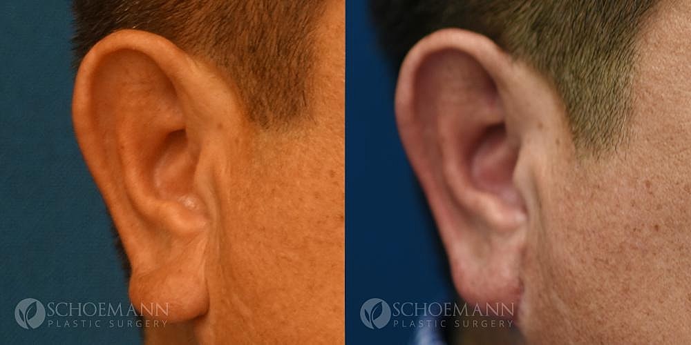 Ear Surgery Before & After