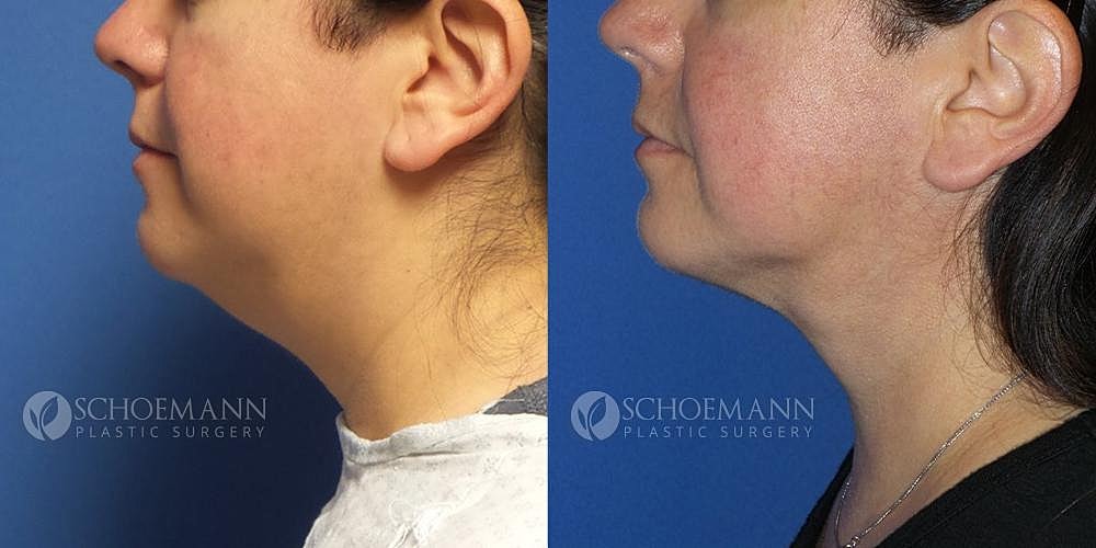 Liposuction Before & After