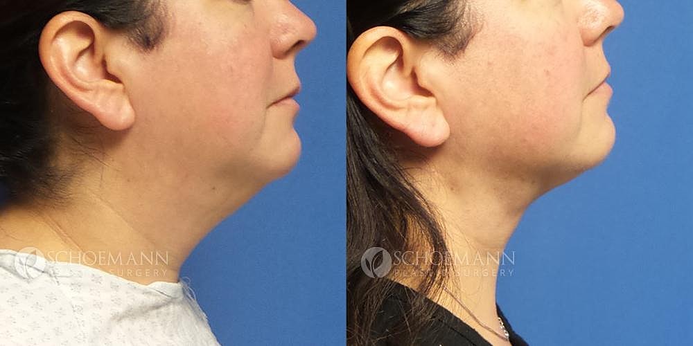 Liposuction Before & After