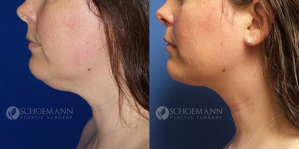 Liposuction Before & After