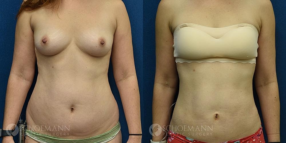 Liposuction Before & After