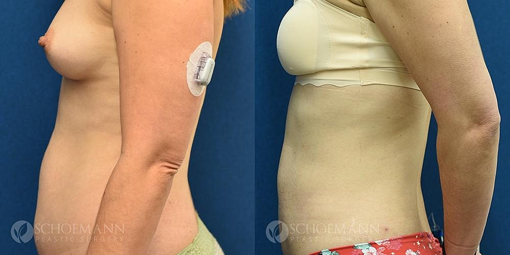 Liposuction Before & After