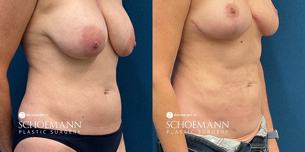 Liposuction Before & After