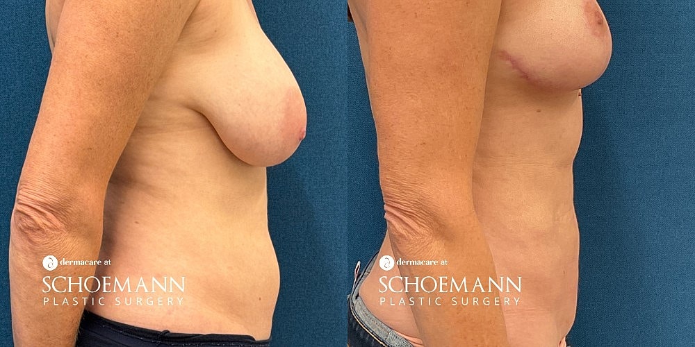 Liposuction Before & After