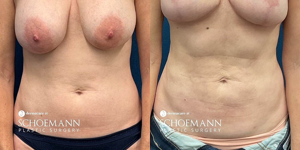 Liposuction Before & After