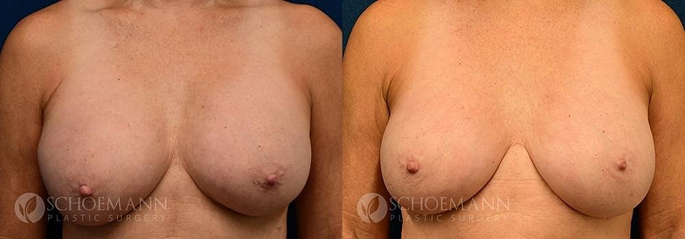 Breast Implant Exchange Before & After