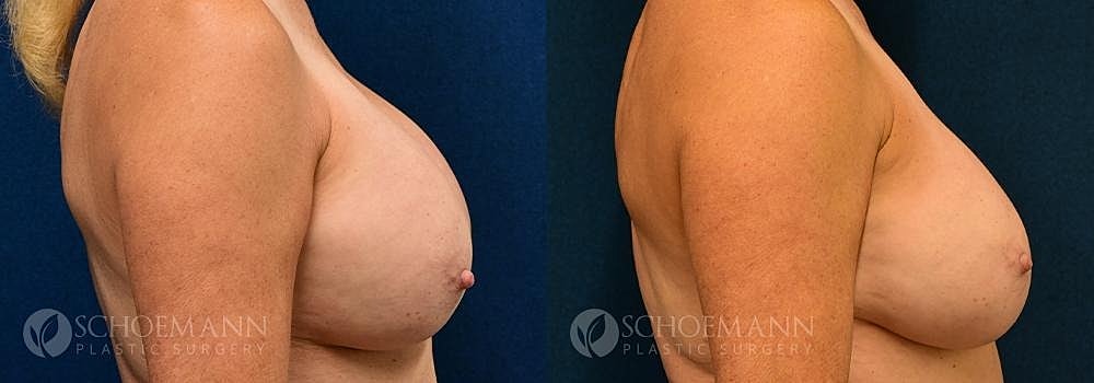 Breast Implant Exchange Before & After