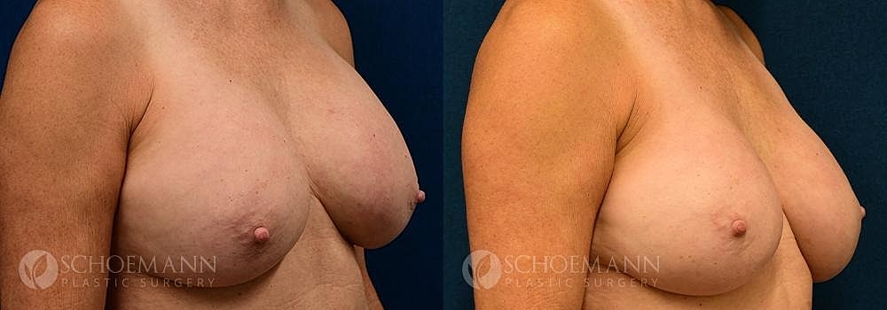 Breast Implant Exchange Before & After