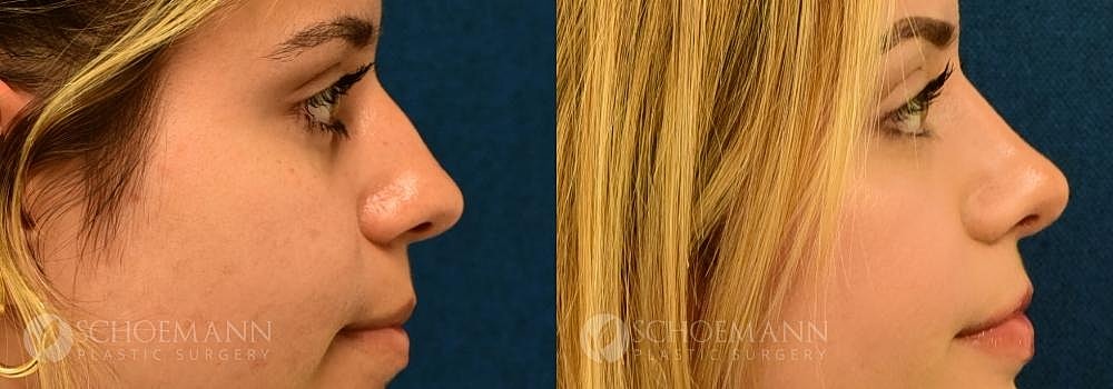 Rhinoplasty Before & After