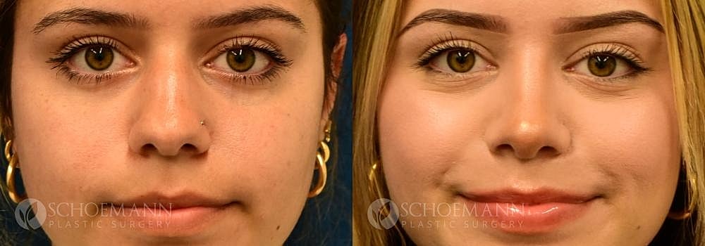 Rhinoplasty Before & After