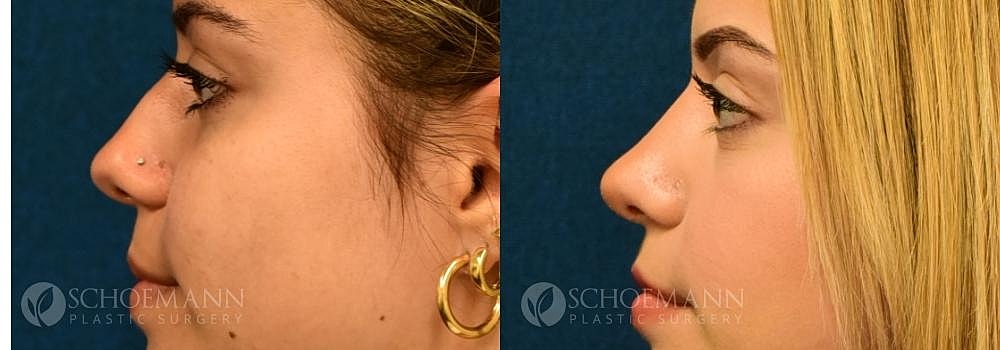Rhinoplasty Before & After