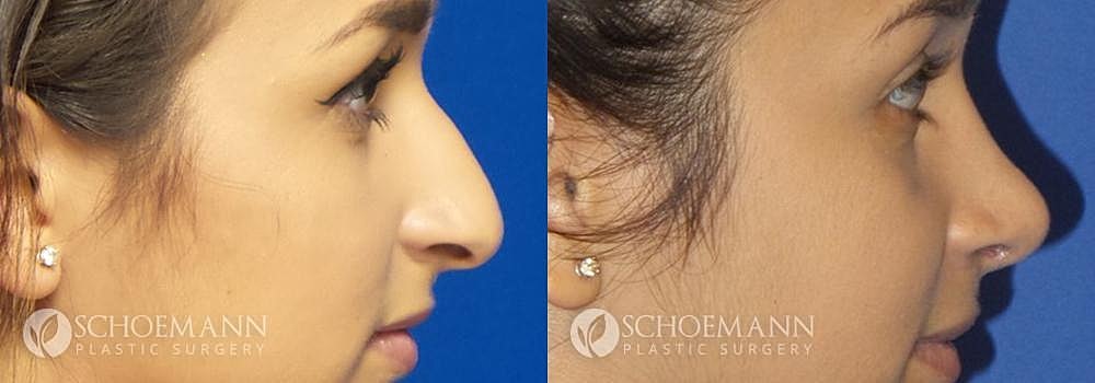 Rhinoplasty Before & After