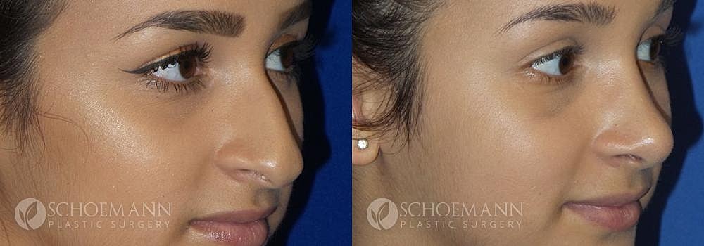 Rhinoplasty Before & After