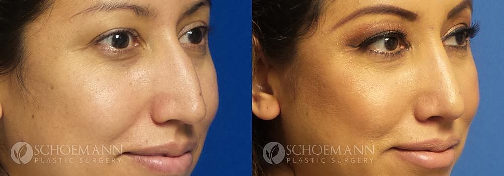 Rhinoplasty Before & After