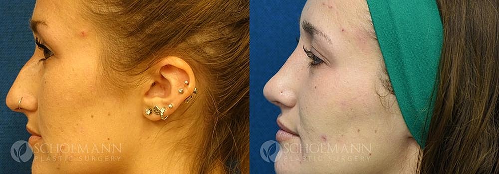 Rhinoplasty Before & After