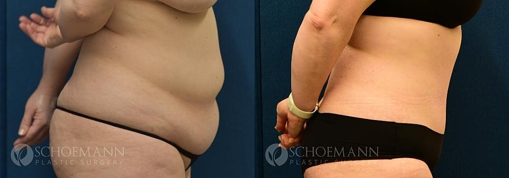 Tummy Tuck Before & After