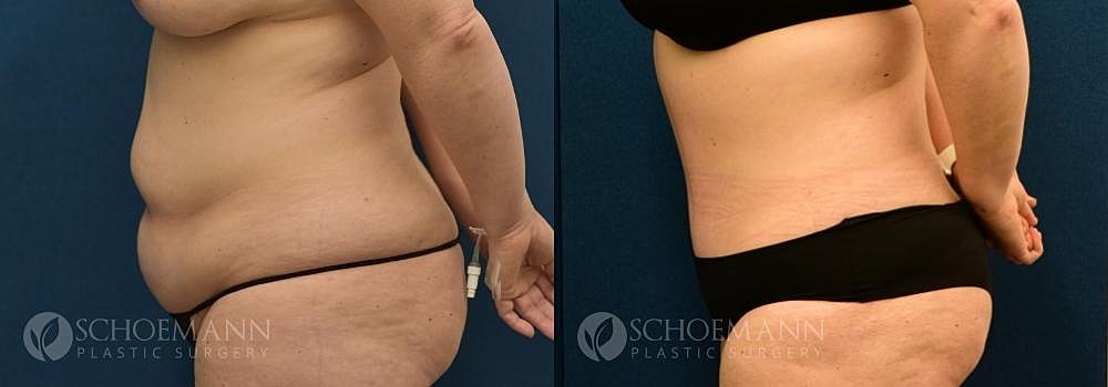 Tummy Tuck Before & After