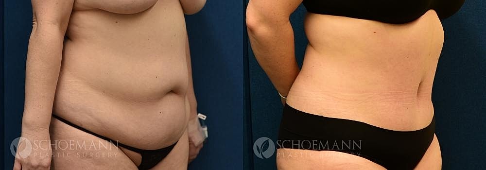 Tummy Tuck Before & After