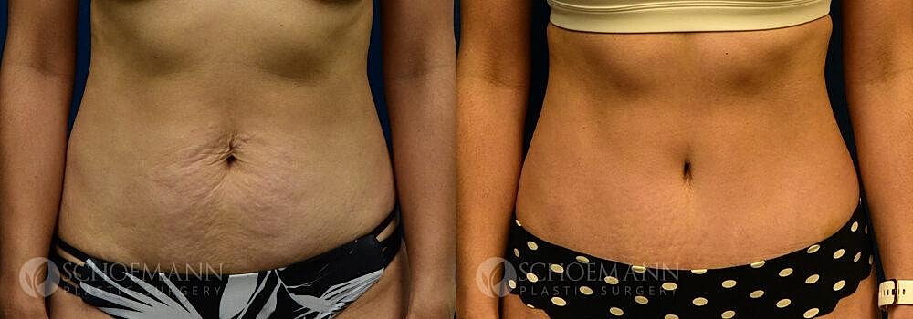 Tummy Tuck Before & After