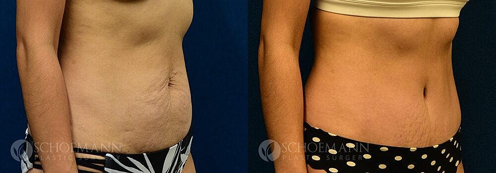 Tummy Tuck Before & After