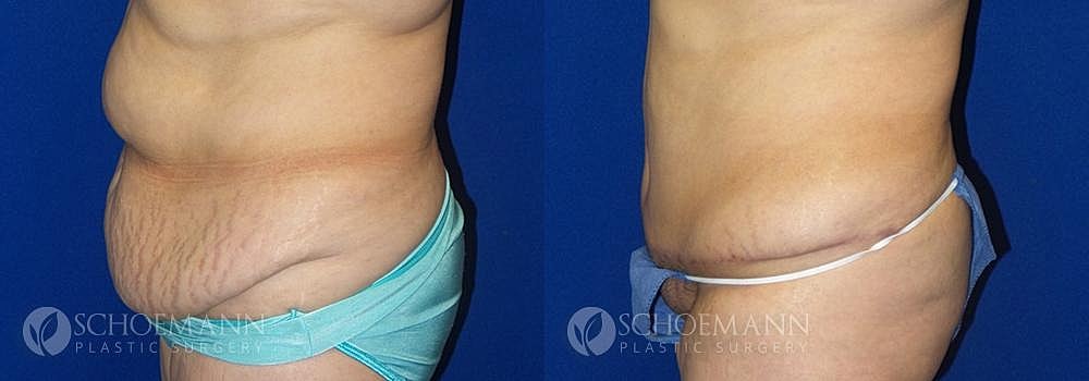 Tummy Tuck Before & After