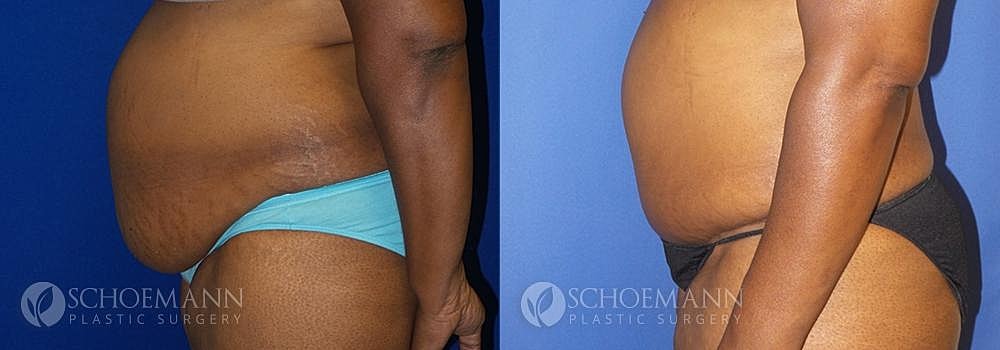 Tummy Tuck Before & After