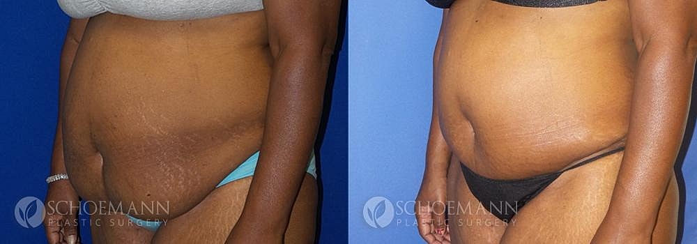 Tummy Tuck Before & After