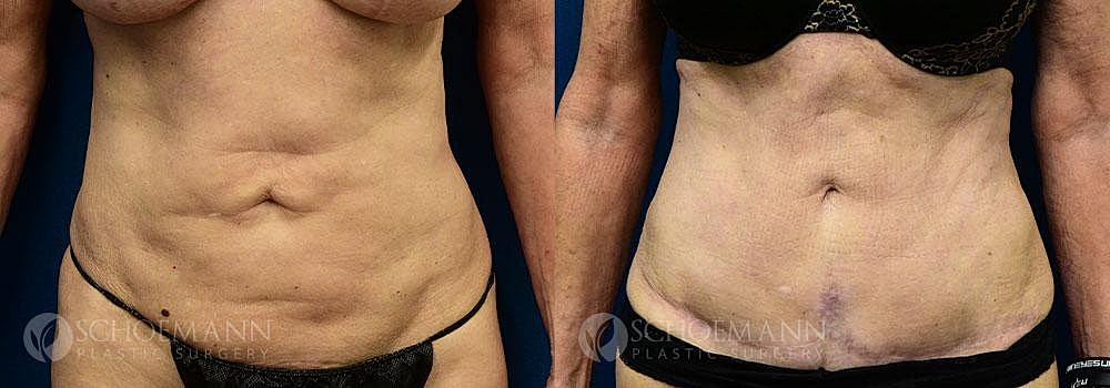 Tummy Tuck Before & After