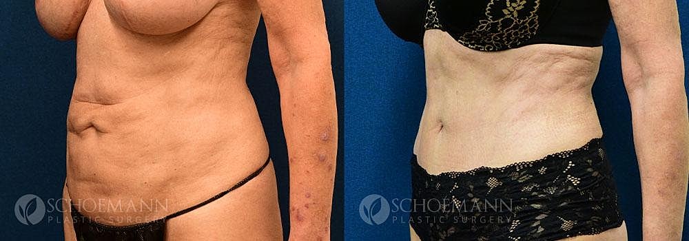 Tummy Tuck Before & After