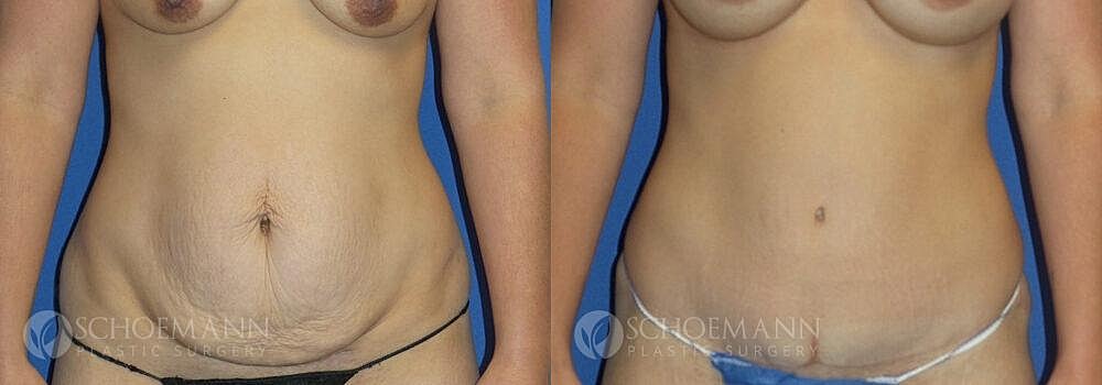 Tummy Tuck Before & After