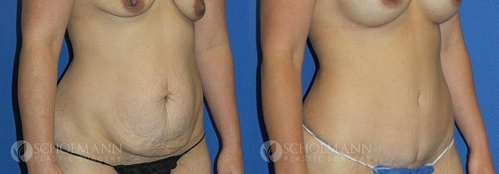 Tummy Tuck Before & After