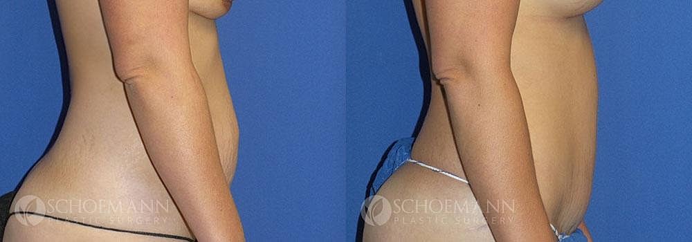 Tummy Tuck Before & After