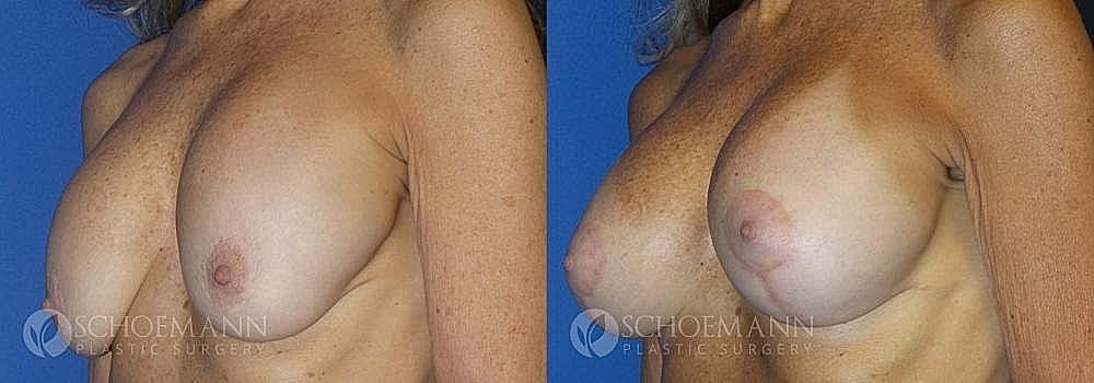 Breast Augmentation and Lift Before & After