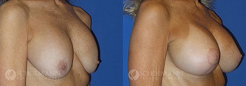Breast Augmentation and Lift Before & After