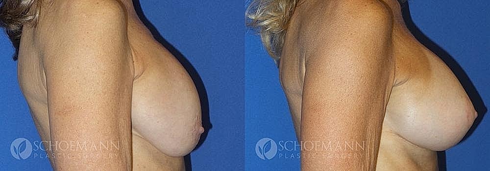 Breast Augmentation and Lift Before & After
