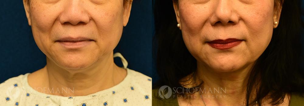 Non Surgical Cheekbone Contouring North County San Diego, San