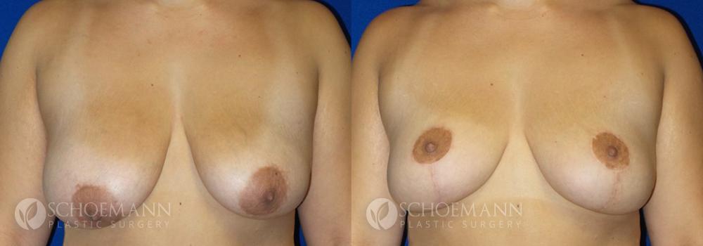 Schoemann-Plastic-Surgery_Encinitas_Breast-Lift-patient-4-1