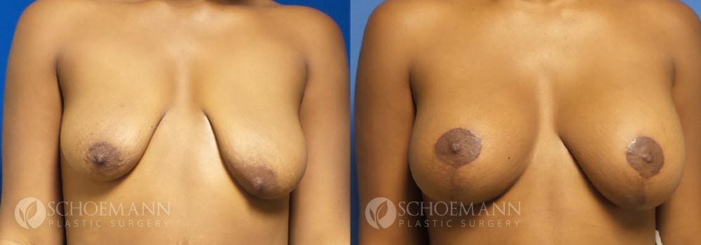 Schoemann-Plastic-Surgery_Encinitas_Breast-Lift-patient-5-1