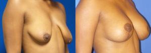 Schoemann-Plastic-Surgery_Encinitas_Breast-Lift-patient-5-2