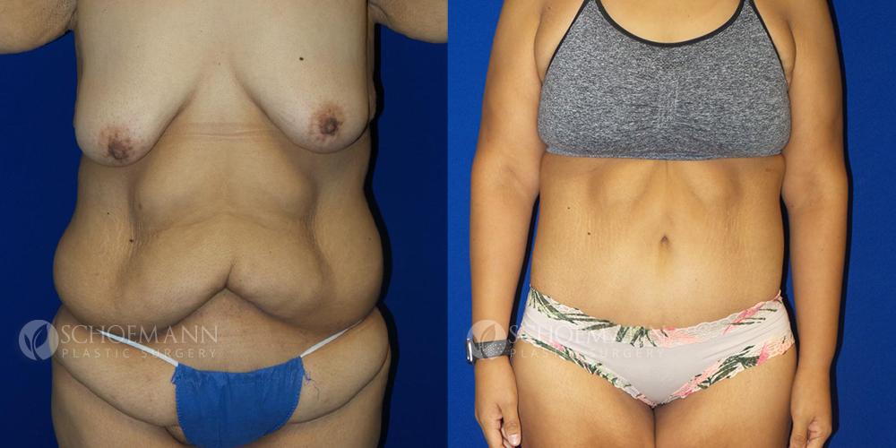 Elegant Body Contouring - Even after weight loss goals have been