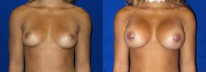 Schoemann-Plastic-Surgery_Encinitas_breast-augmentation-patient-1-1