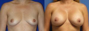 Schoemann-Plastic-Surgery_Encinitas_breast-augmentation-patient-10-1