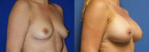 Schoemann-Plastic-Surgery_Encinitas_breast-augmentation-patient-10-2