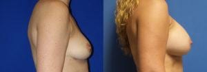 Schoemann-Plastic-Surgery_Encinitas_breast-augmentation-patient-10-3