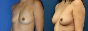 Schoemann-Plastic-Surgery_Encinitas_breast-augmentation-patient-11-2
