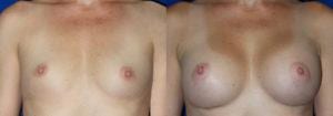 Breast Augmentation Patient 2-1