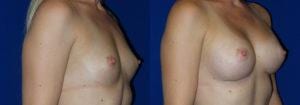 Schoemann-Plastic-Surgery_Encinitas_breast-augmentation-patient-2-2