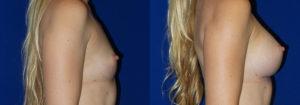 Schoemann-Plastic-Surgery_Encinitas_breast-augmentation-patient-2-3
