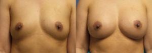 Schoemann-Plastic-Surgery_Encinitas_breast-augmentation-patient-3-1