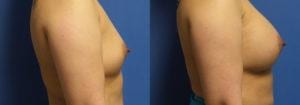 Schoemann-Plastic-Surgery_Encinitas_breast-augmentation-patient-3-3